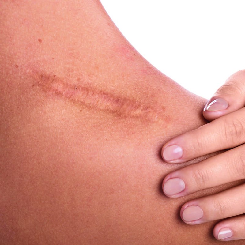 Hand resting over a scar