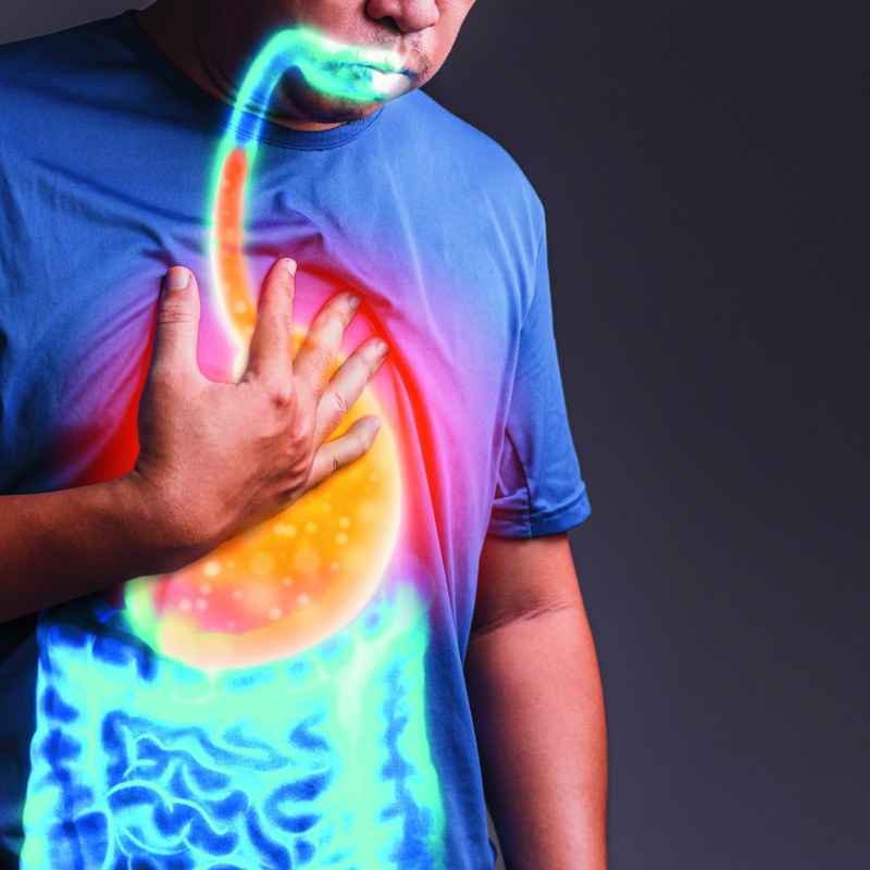 Illustration of acid reflux in the digestive tract