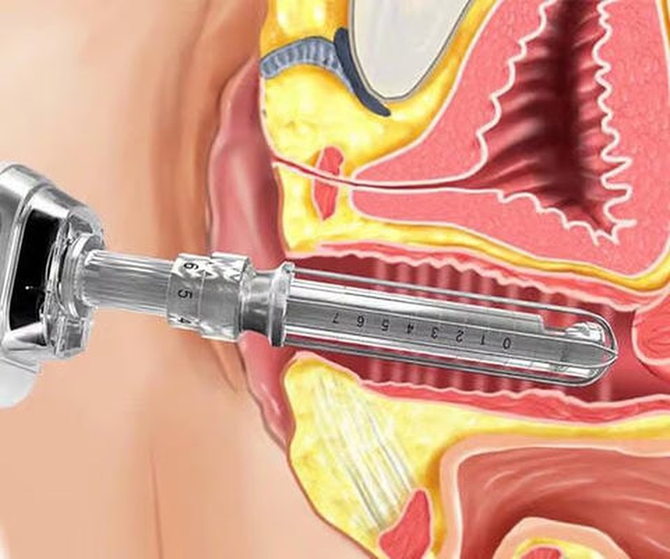 Cross-section diagram of the Femilift laser treatment